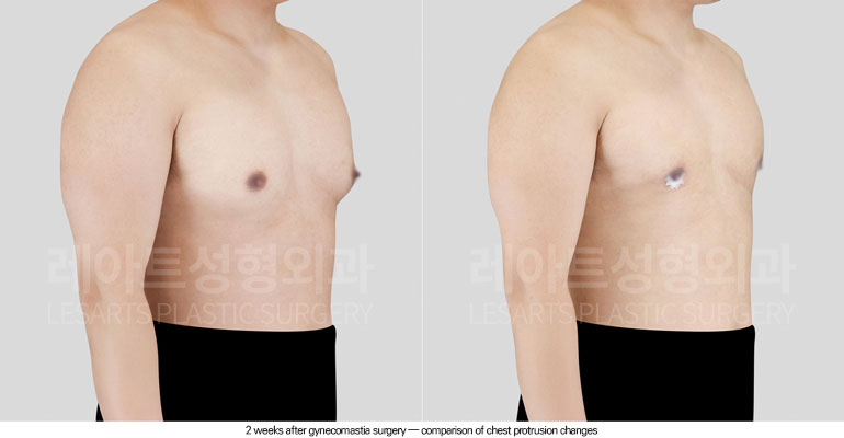 gynecomastia-02-03-260601