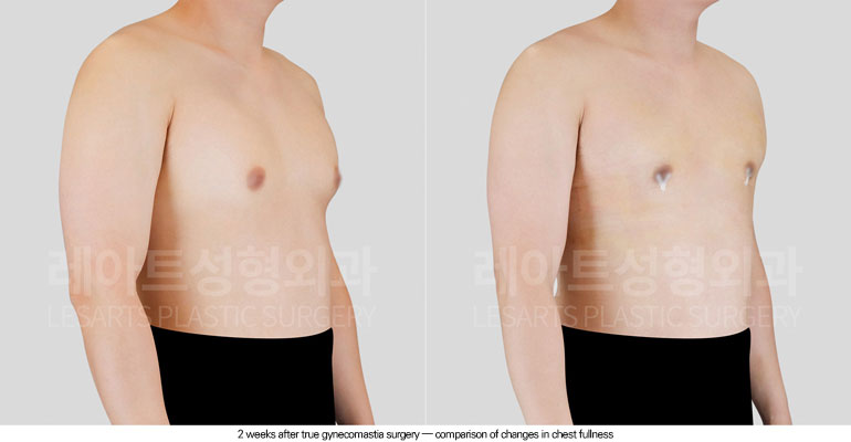 gynecomastia-02-03-260604