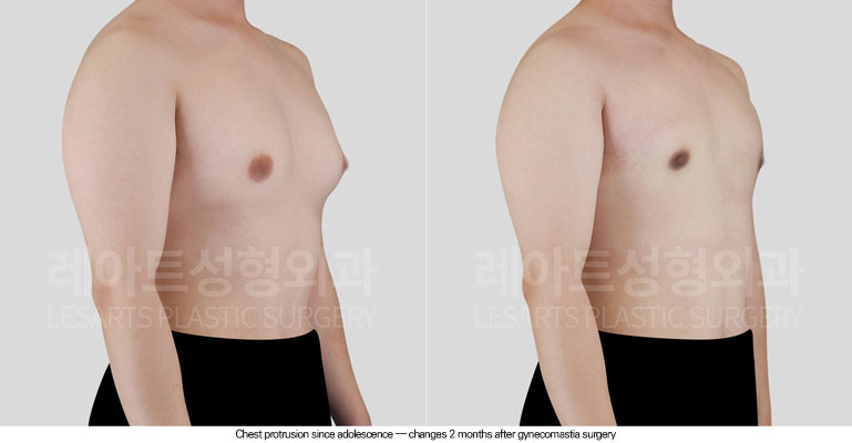 gynecomastia-02-03-260608
