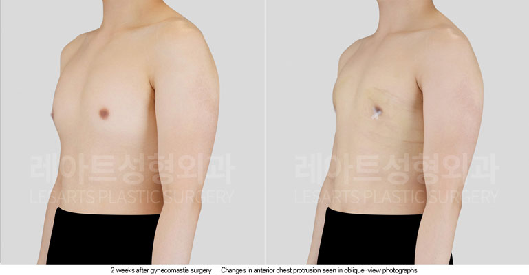 gynecomastia-02-03-260615