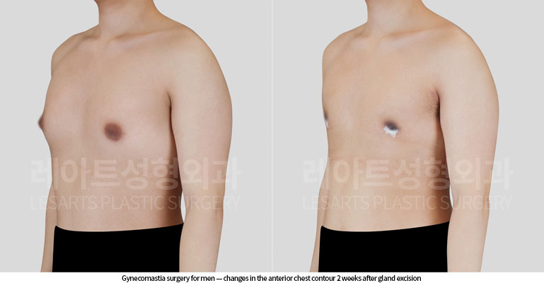 gynecomastia-02-03-260617