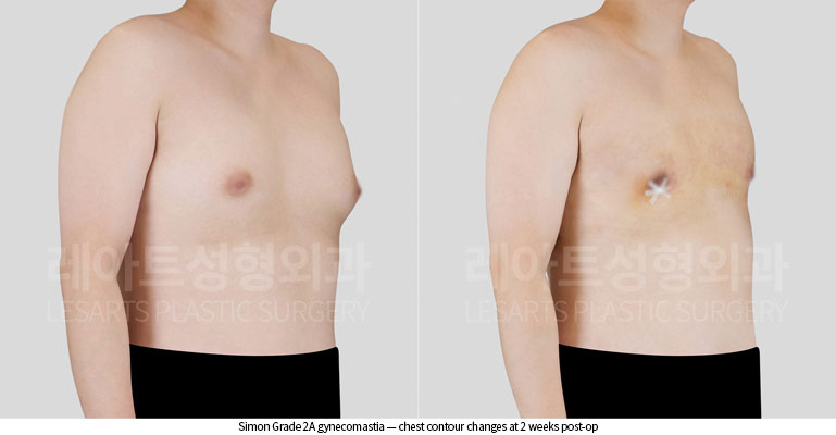 gynecomastia-02-03-260622