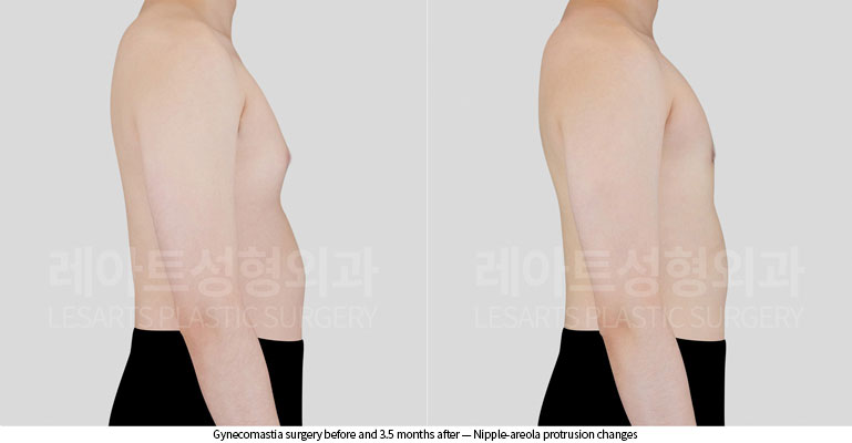 gynecomastia-02-04-260528