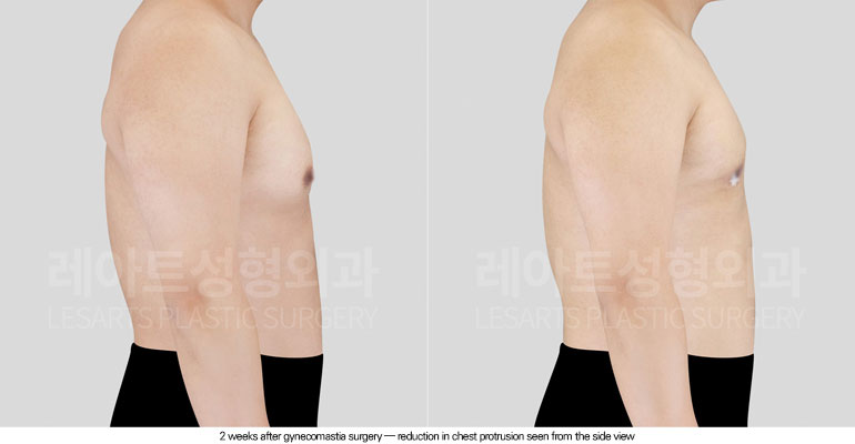 gynecomastia-02-04-260601