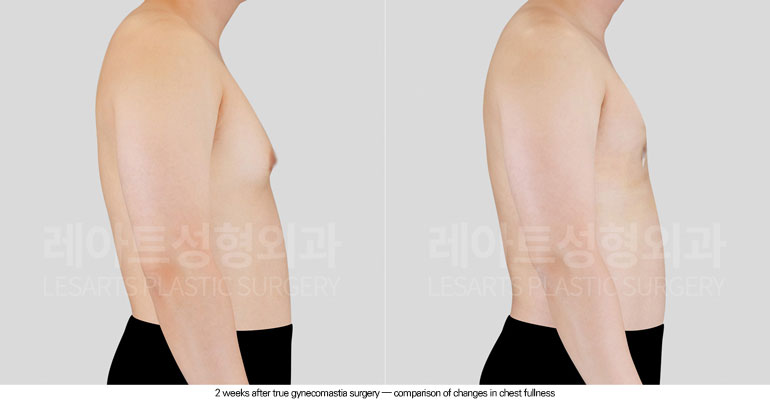 gynecomastia-02-04-260604
