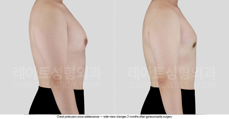 gynecomastia-02-04-260608