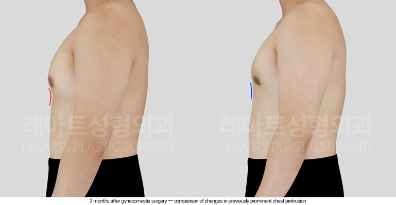 gynecomastia-02-04-260611