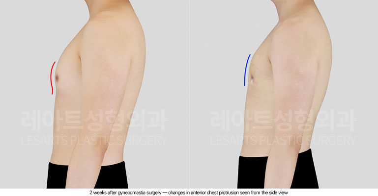 gynecomastia-02-04-260615