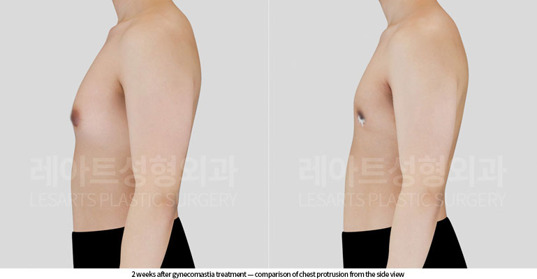 gynecomastia-02-04-260617