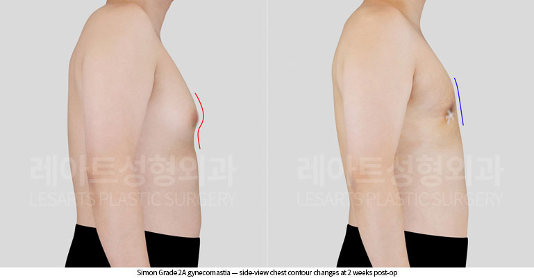 gynecomastia-02-04-260622