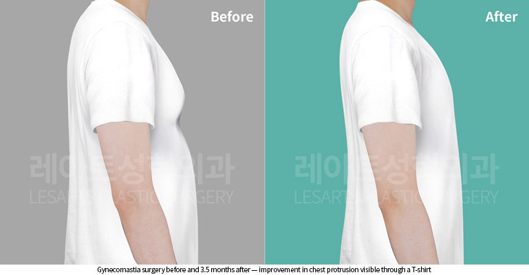 gynecomastia-02-05-260528