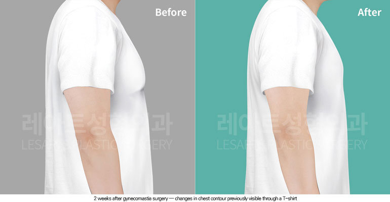 gynecomastia-02-05-260601