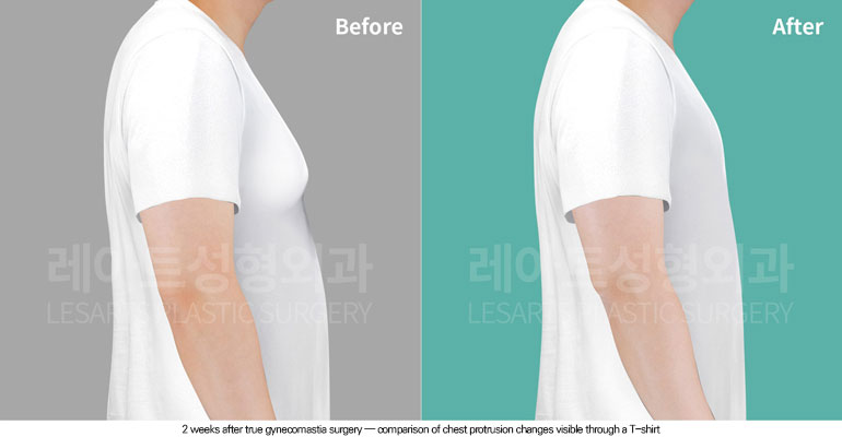 gynecomastia-02-05-260604