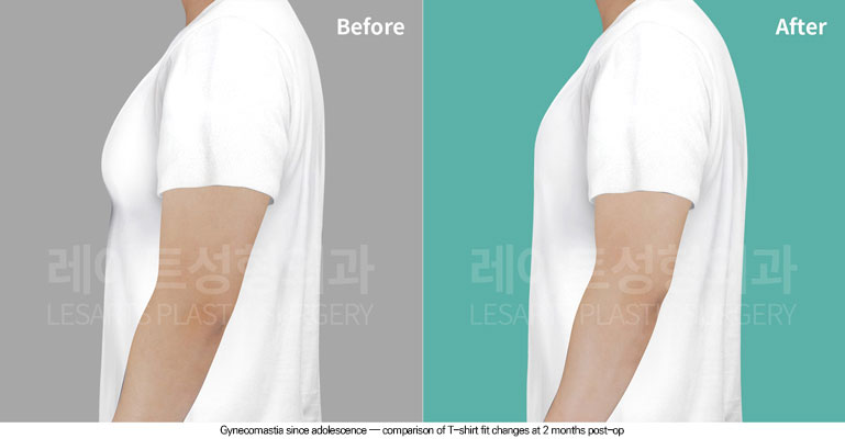 gynecomastia-02-05-260611