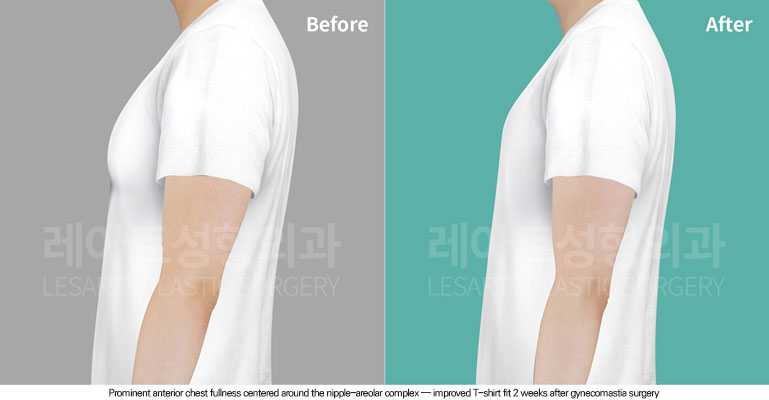 gynecomastia-02-05-260615