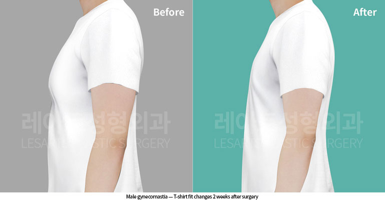 gynecomastia-02-05-260617