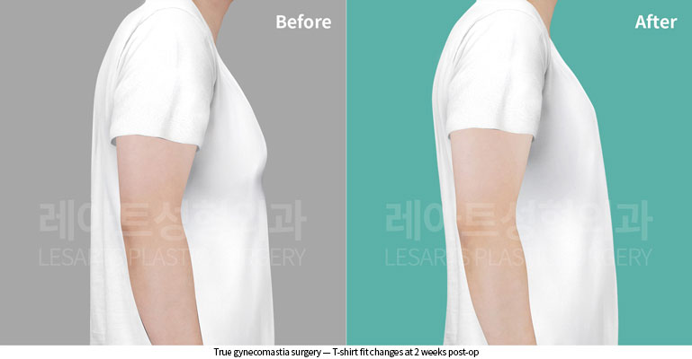 gynecomastia-02-05-260622