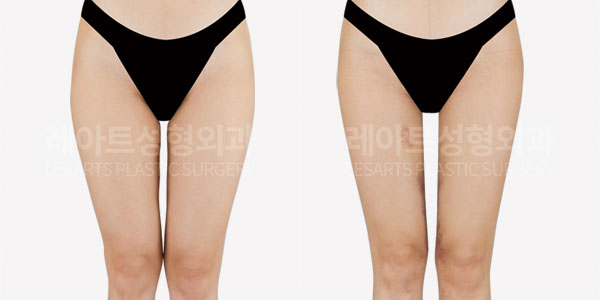 thigh liposuction before and after-lesarts plastic surgery