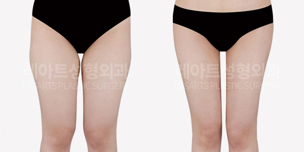 thigh liposuction before and after-lesarts plastic surgery