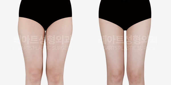 thigh liposuction before and after-lesarts plastic surgery