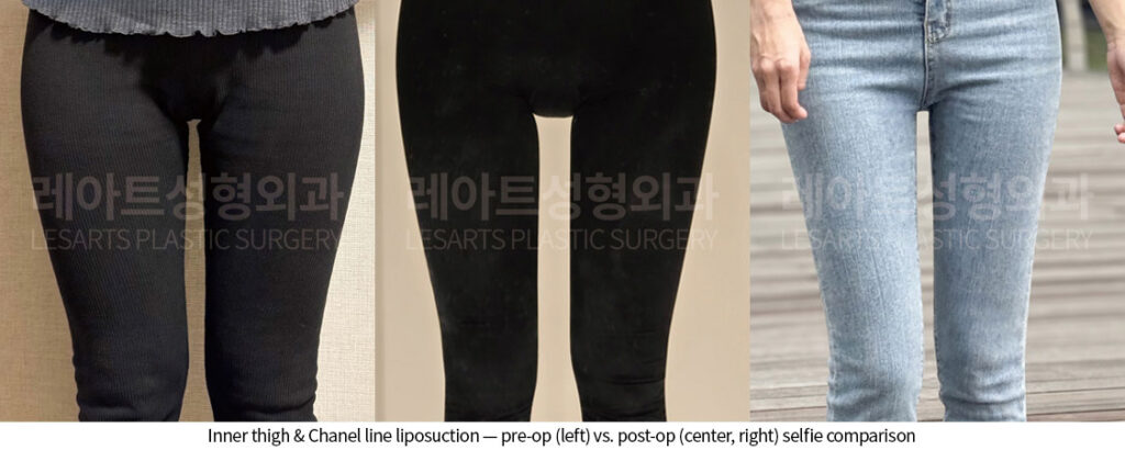 thigh-liposuction-02-01-260528