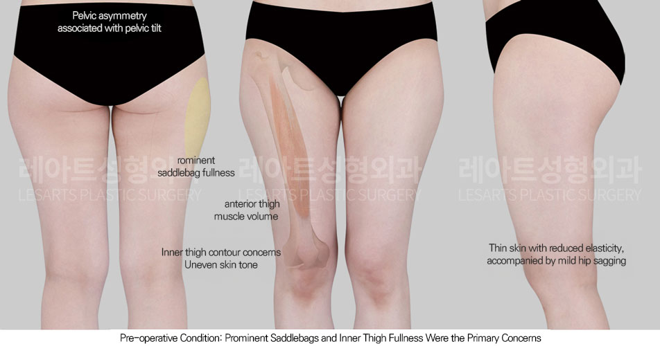 thigh-liposuction-02-01-260601