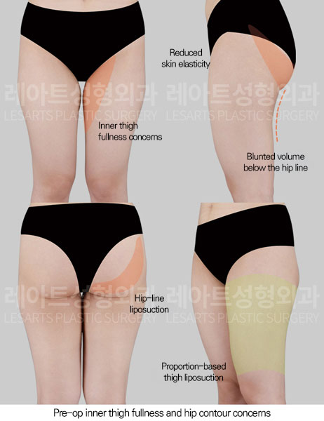 thigh-liposuction-02-01-260611