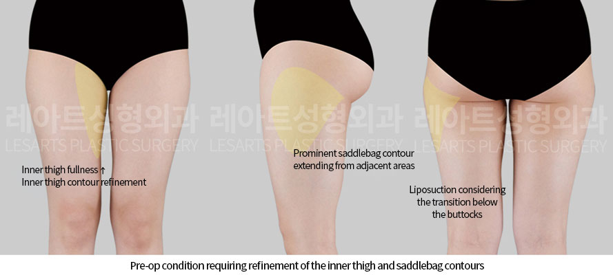 thigh-liposuction-02-01-260618
