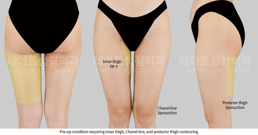 thigh-liposuction-02-02-260528