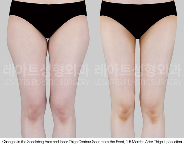 thigh-liposuction-02-02-260601