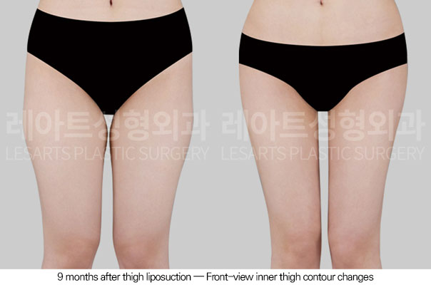 thigh-liposuction-02-02-260611