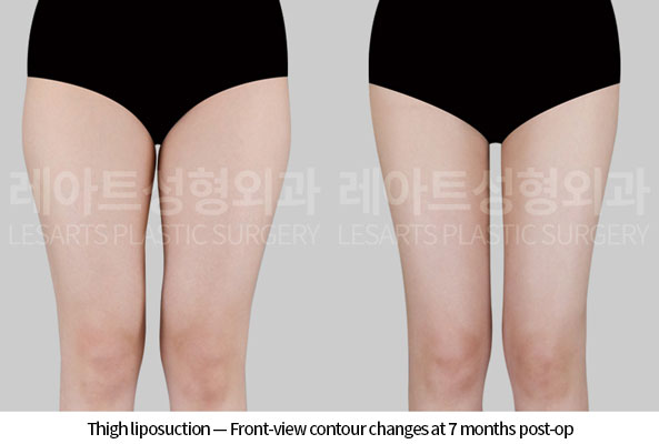 thigh-liposuction-02-02-260618