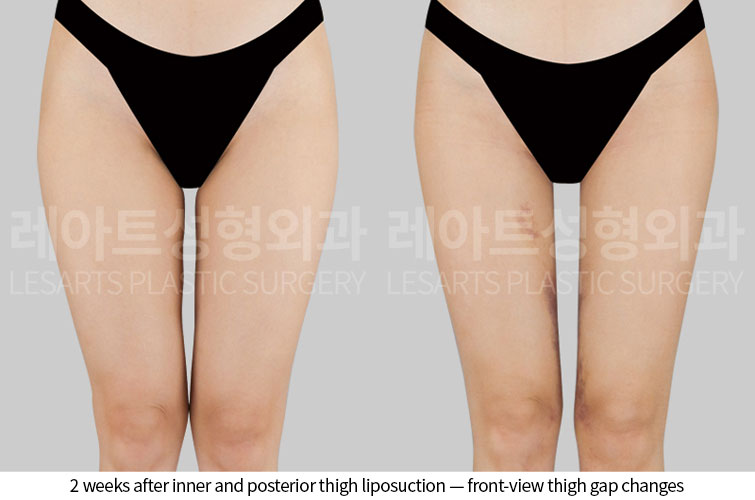 thigh-liposuction-02-03-260528