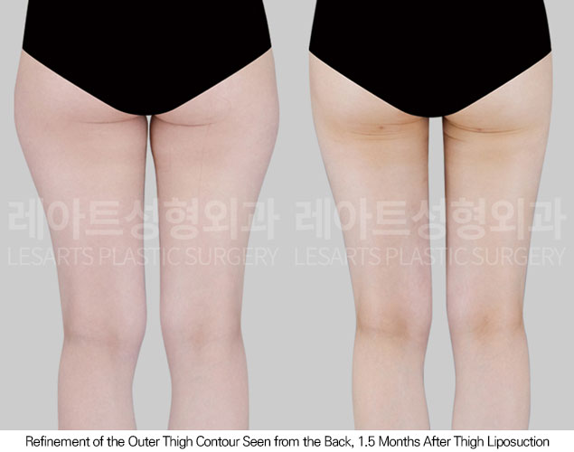thigh-liposuction-02-03-260601