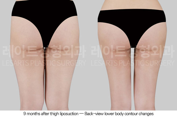 thigh-liposuction-02-03-260611