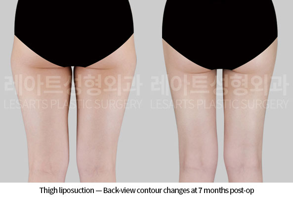 thigh-liposuction-02-03-260618