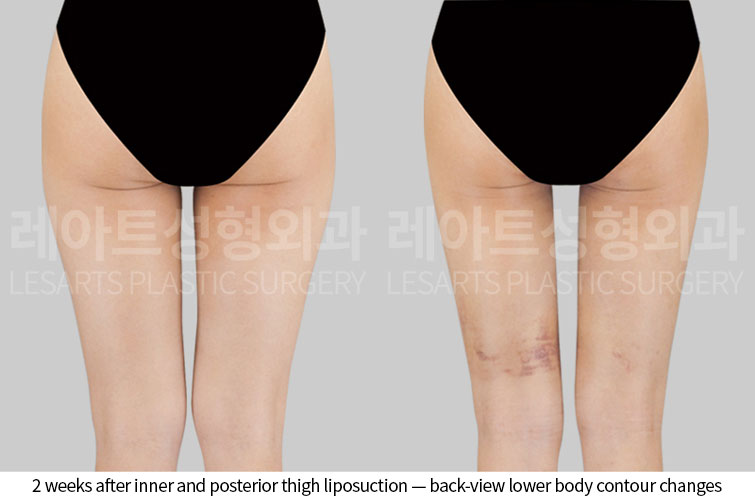 thigh-liposuction-02-04-260528
