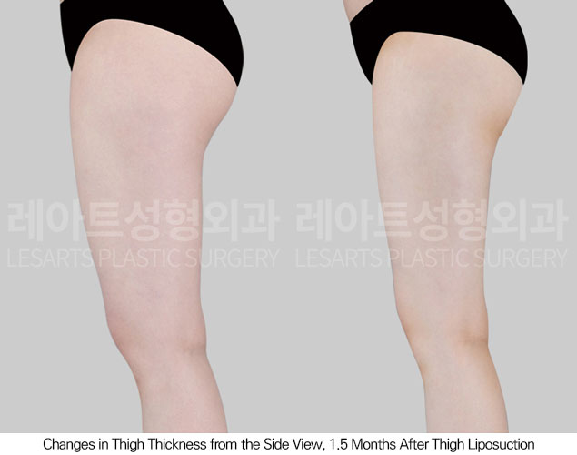 thigh-liposuction-02-04-260601