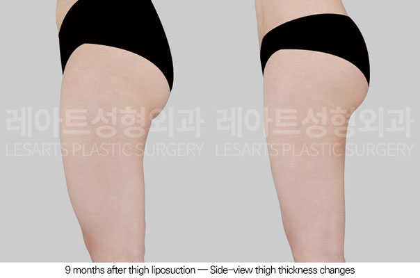 thigh-liposuction-02-04-260611