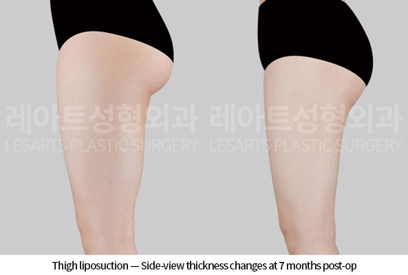 thigh-liposuction-02-04-260618