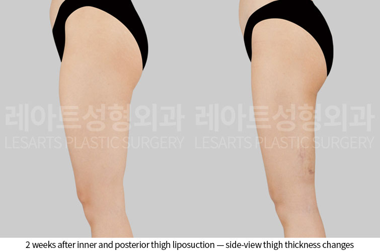 thigh-liposuction-02-05-260528