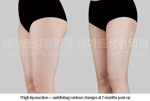 thigh-liposuction-02-05-260618