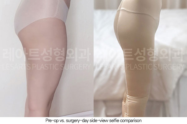 thigh-liposuction-02-06-260611