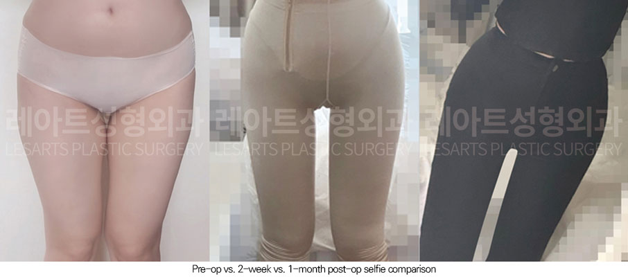 thigh-liposuction-02-07-260611