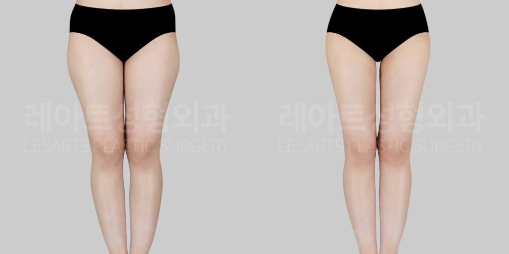 lesarts liposuction before and after