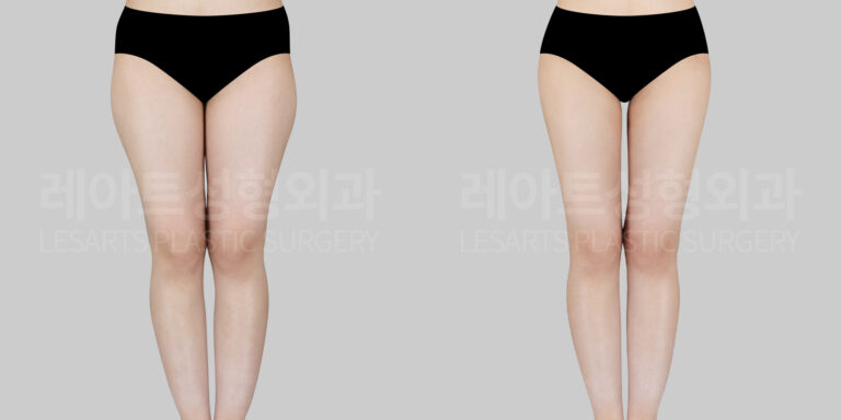 lesarts liposuction before and after