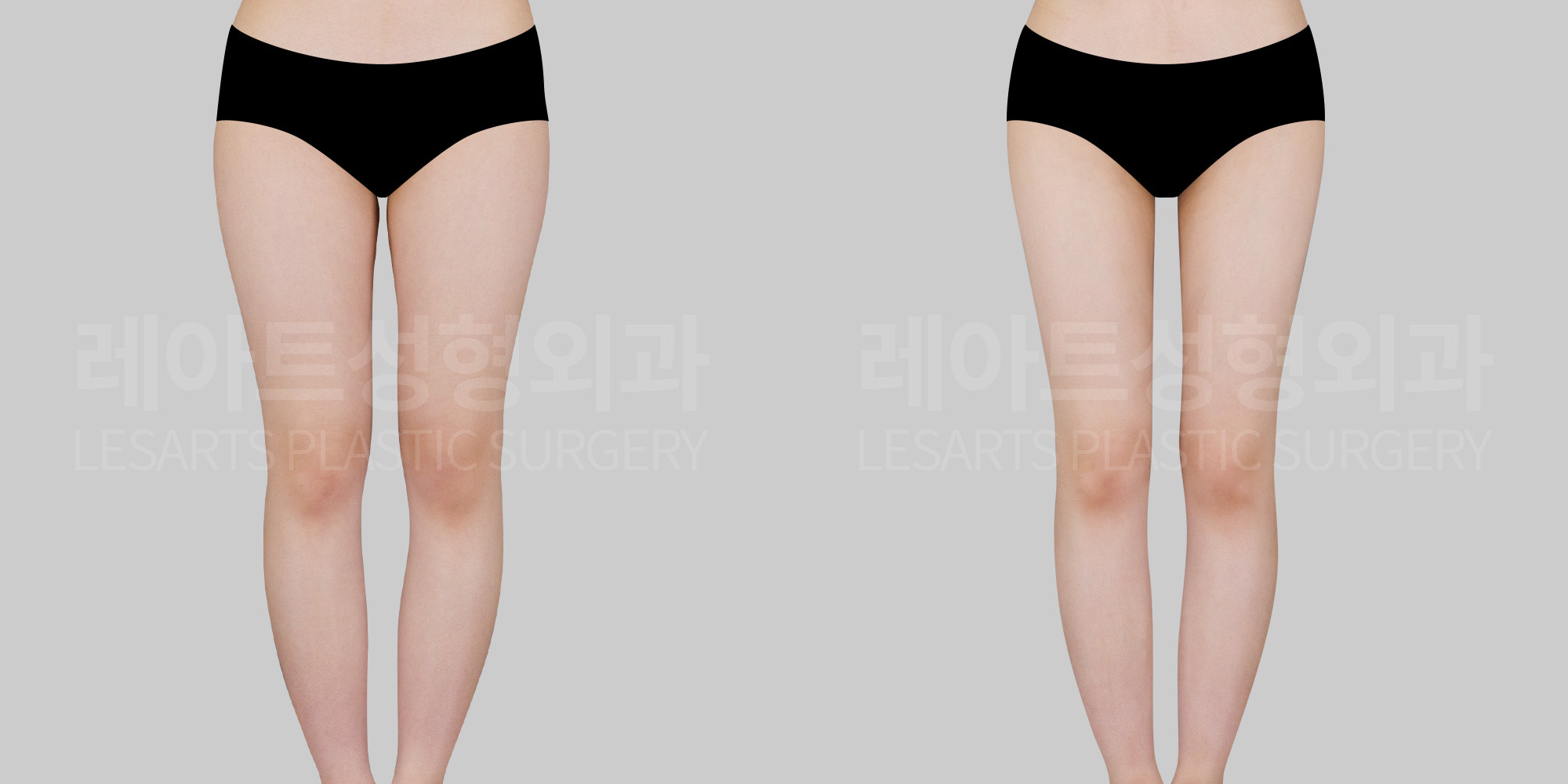 thigh-liposuction-26771-bna-front