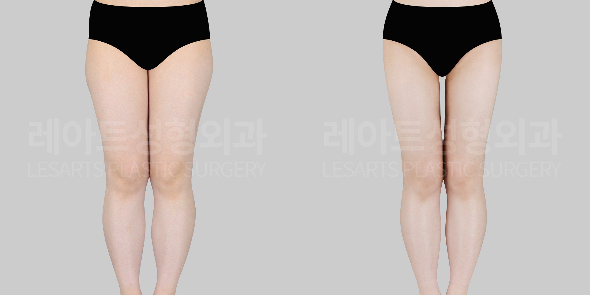 Thigh Liposuction-Why Thighs Feel Firm: It’s Not Just MuscleHow to Target the Hidden Layer of Fat