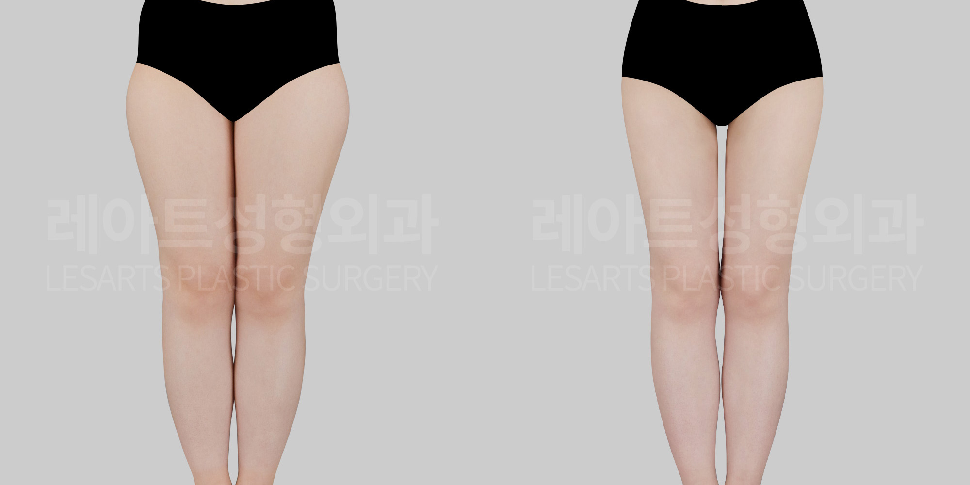 thigh-liposuction-before and after