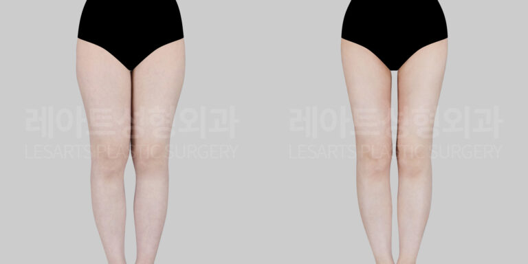 thigh liposuction before and after(lesarts)